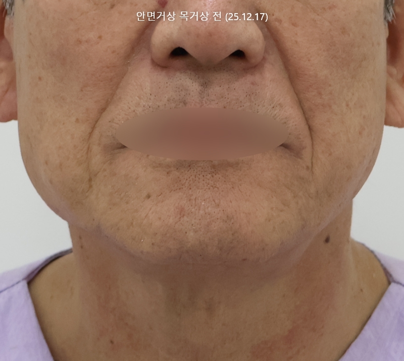 더올림성형외과 하안검수술 전사진