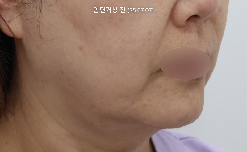 더올림성형외과 하안검수술 전사진