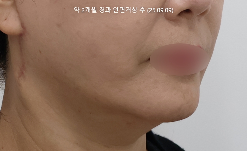 더올림성형외과 하안검수술 후사진 3개월경과