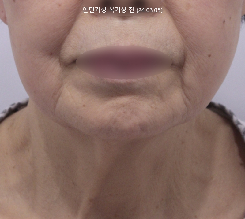 더올림성형외과 중안면거상 전사진