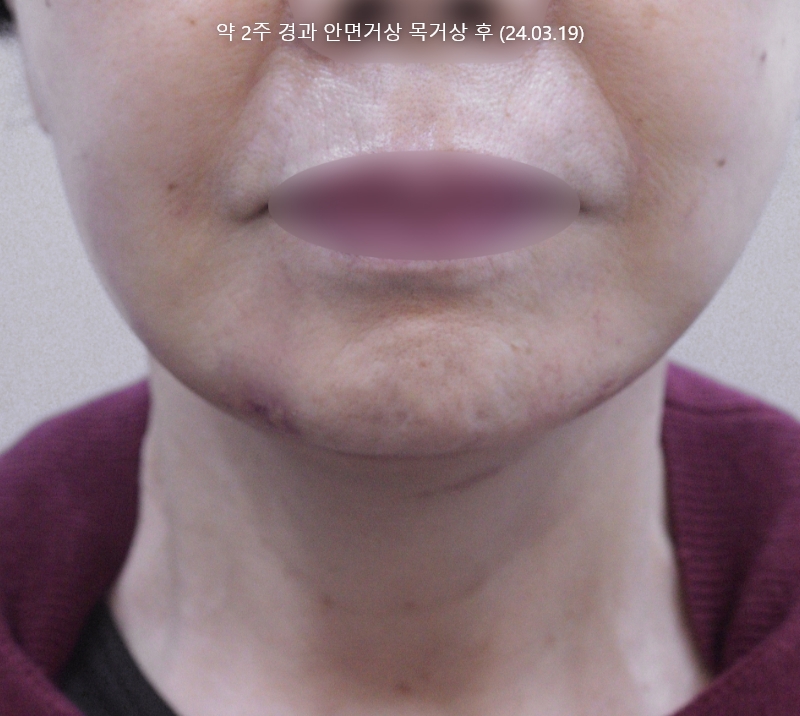 더올림성형외과 중안면거상 후사진 4개월경과