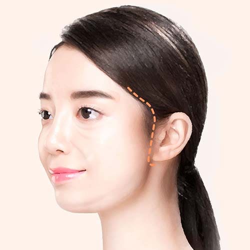 안면거상수술방법1디자인
