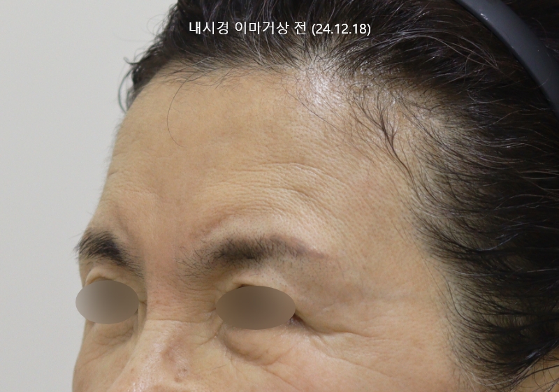 더올림성형외과 하안검수술 전사진