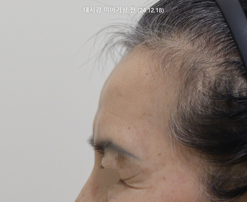 더올림성형외과 중안면거상 전사진