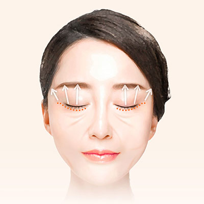 중안면거상수술방법3당김