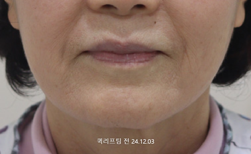 더올림성형외과 퀵리프팅 전사진