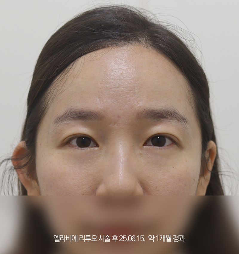 더올림성형외과 리투오 시술 후사진