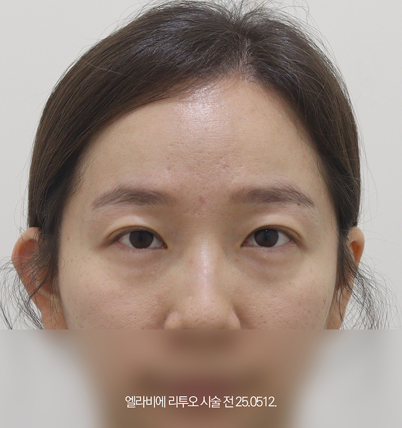 더올림성형외과 리투오 시술 전사진