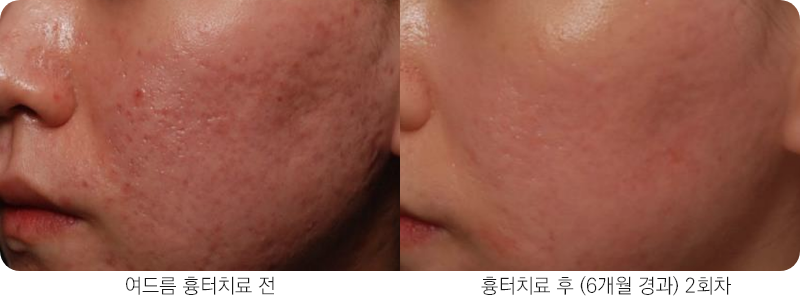 앙코르레이저 여드름흉터 6개월경과