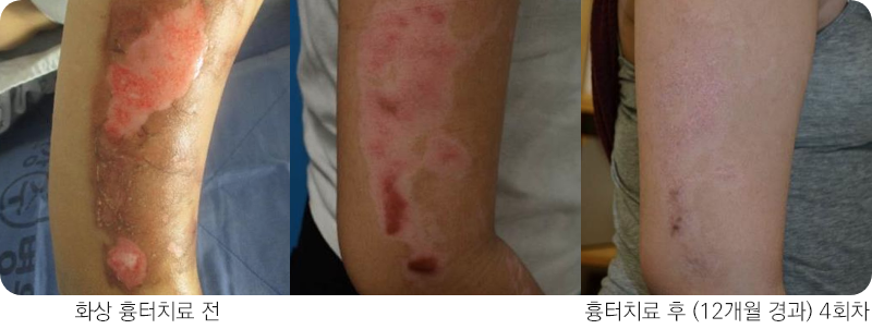 앙코르레이저 화상흉터 12개월경과