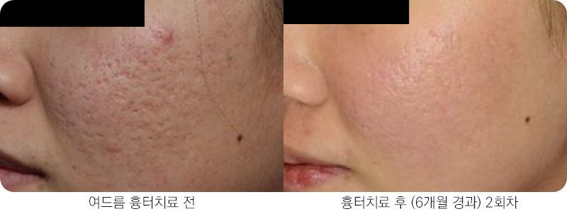 앙코르레이저 여드름흉터 6개월경과