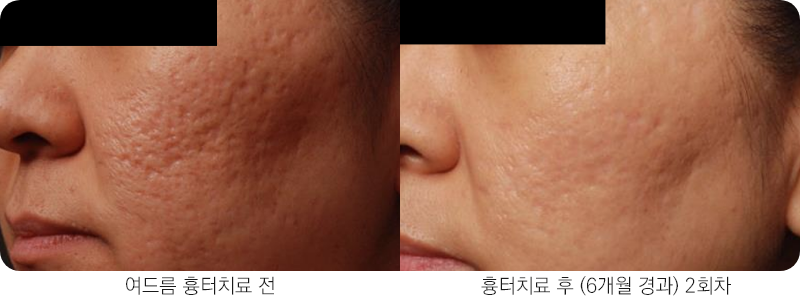 앙코르레이저 여드름흉터 6개월경과