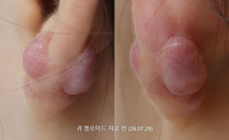 캘로이드흉터 약1개월 경과