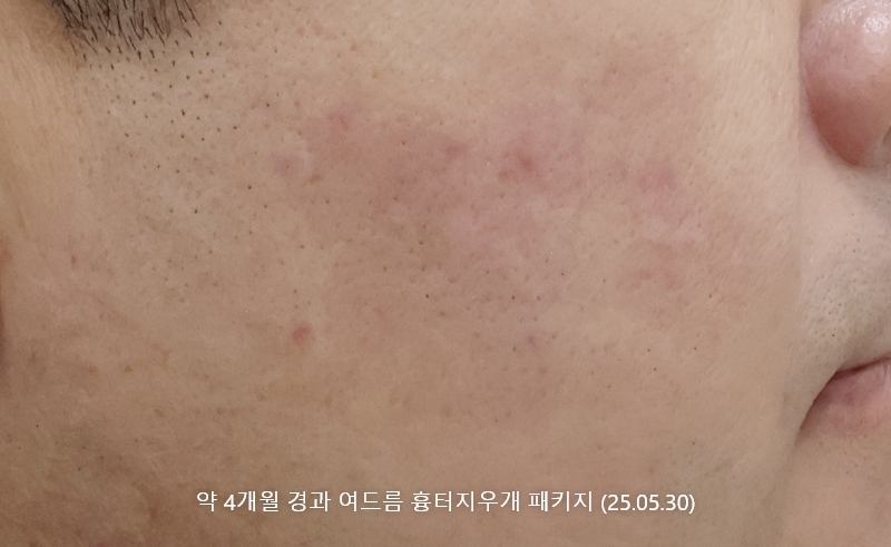 앙코르레이저 여드름흉터 4개월경과