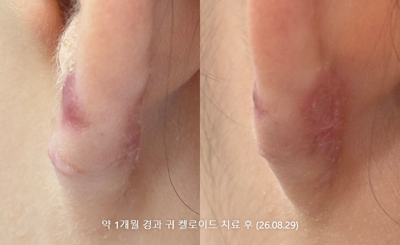 캘로이드흉터 약1개월 경과