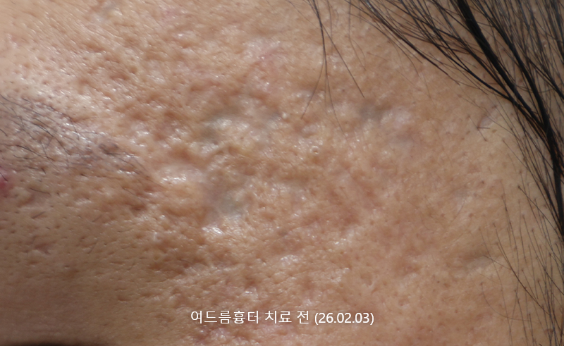 여드름흉터 약2개월 경과