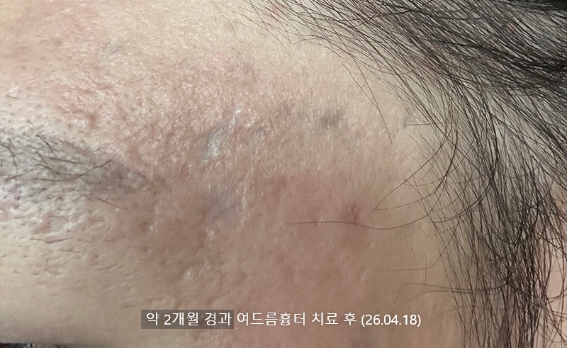 여드름흉터 약2개월 경과