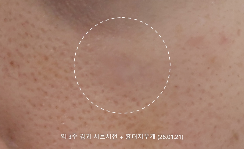 앙코르레이저 여드름흉터 3주경과