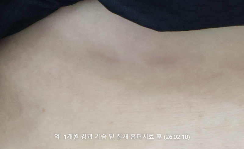 가슴밑절개흉터 약1개월 경과