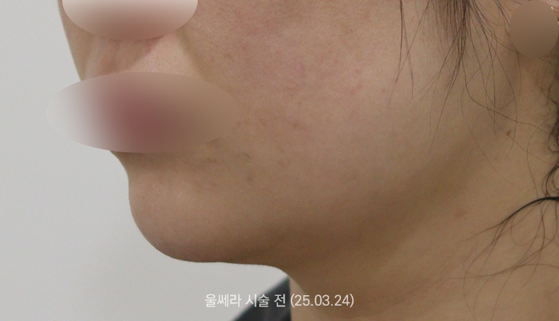 더올림성형외과 울쎄라 전사진