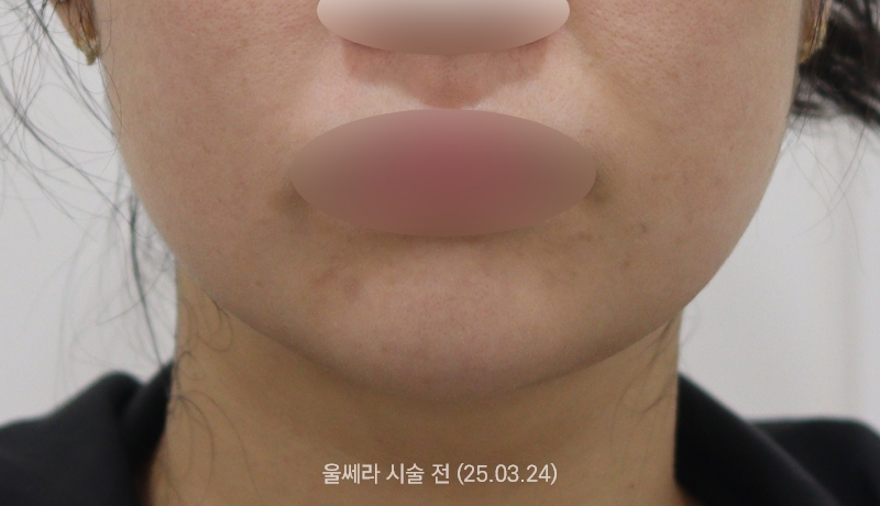 더올림성형외과 울쎄라 전사진