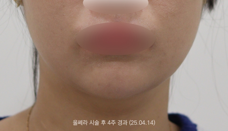 더올림성형외과 울쎄라 후사진 1개월경과
