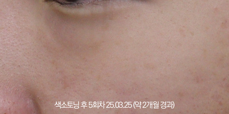 더올림성형외과 토닝 2개월경과