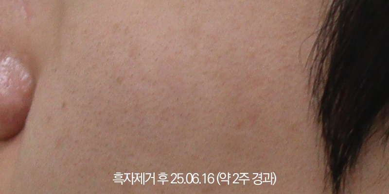 더올림성형외과 흑자제거 1개월경과