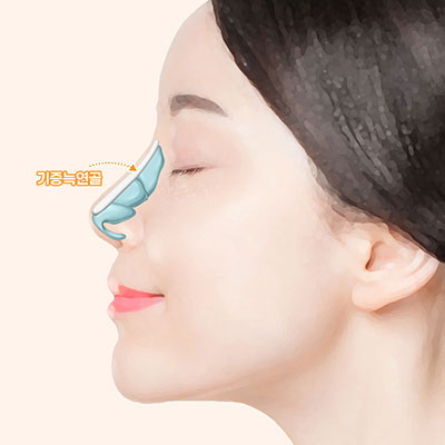 기증늑연골코재수술방법3재삽입