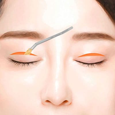 절개쌍꺼풀수술방법2최소절개