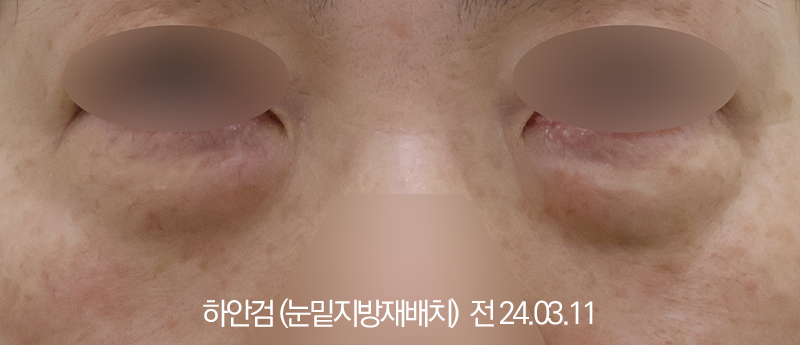 더올림성형외과 하안검수술 전사진