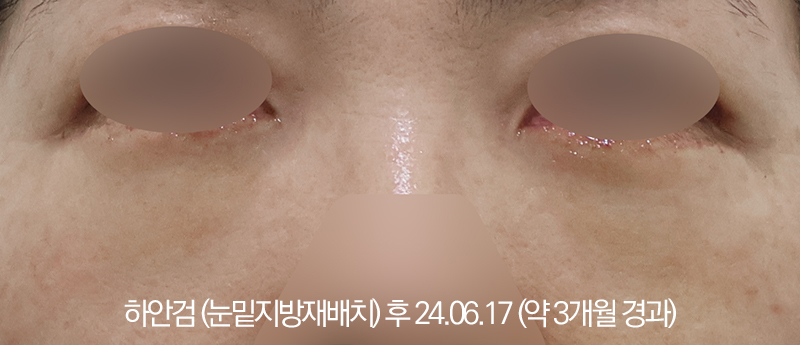 더올림성형외과 하안검수술 후사진 3개월경과