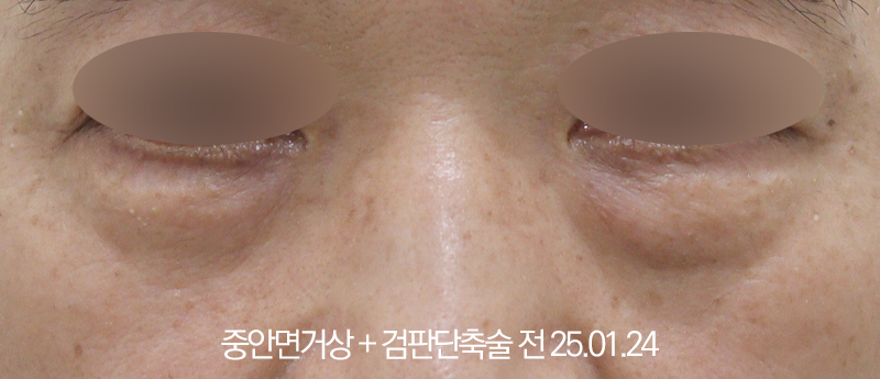 더올림성형외과 중안면거상 전사진