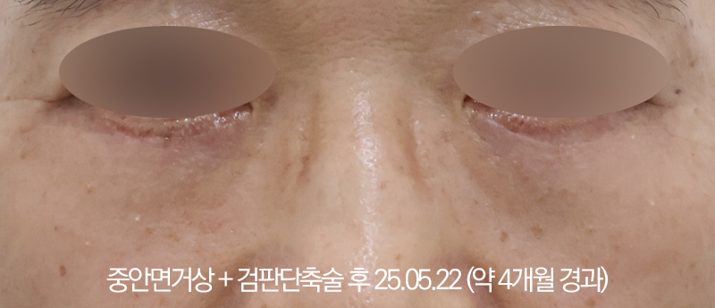 더올림성형외과 중안면거상 후사진 4개월경과