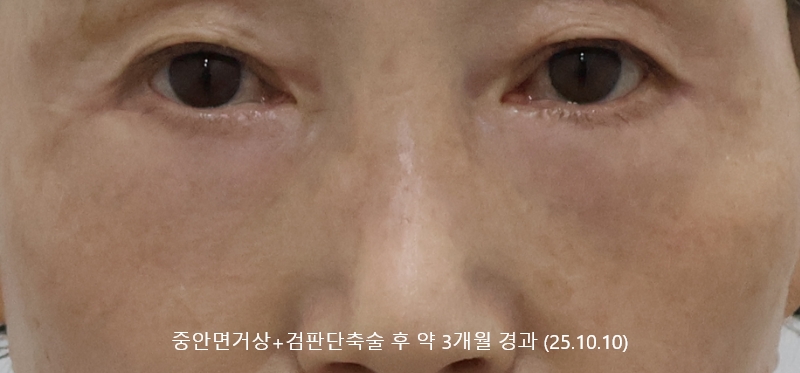 더올림성형외과 중안면거상 후사진 3개월경과