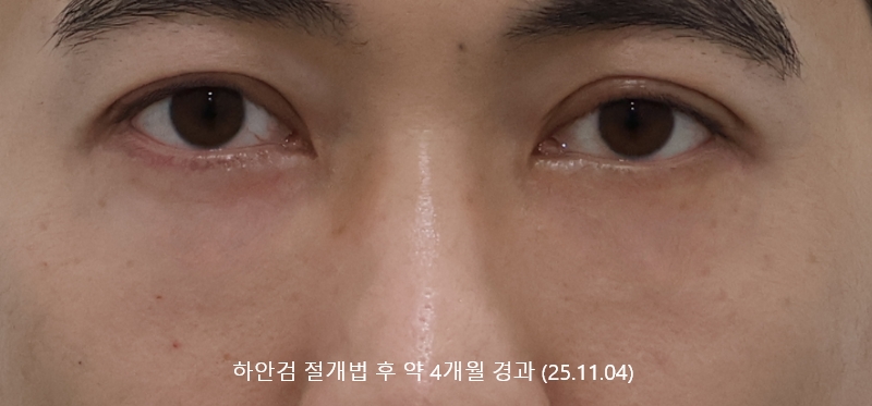 더올림성형외과 하안검절개 후사진 4개월경과