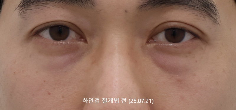 더올림성형외과 하안검절개 전사진
