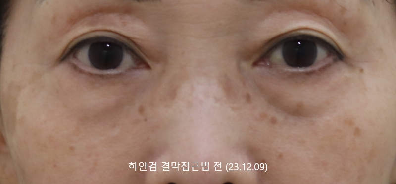 더올림성형외과 하안검결막 전사진