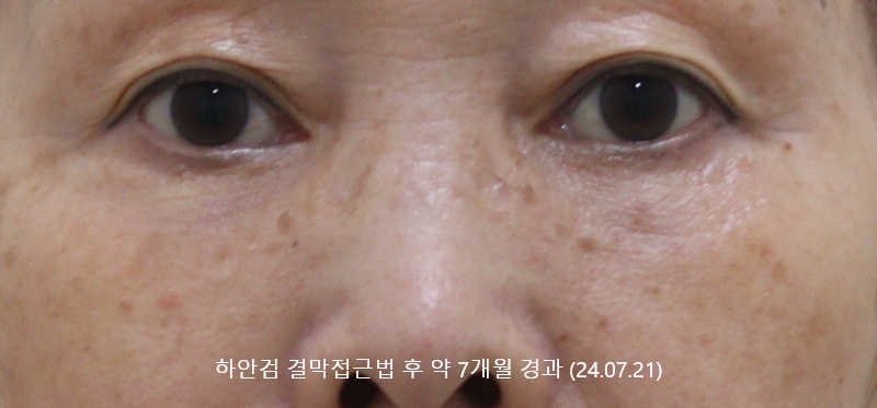 더올림성형외과 하안검결막 후사진 7개월경과