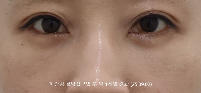 더올림성형외과 하안검결막 후사진 1개월경과