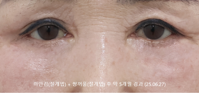 더올림성형외과 하안검절개 후사진 5개월경과