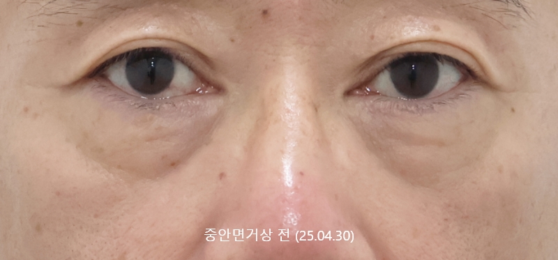 더올림성형외과 중안면거상 전사진