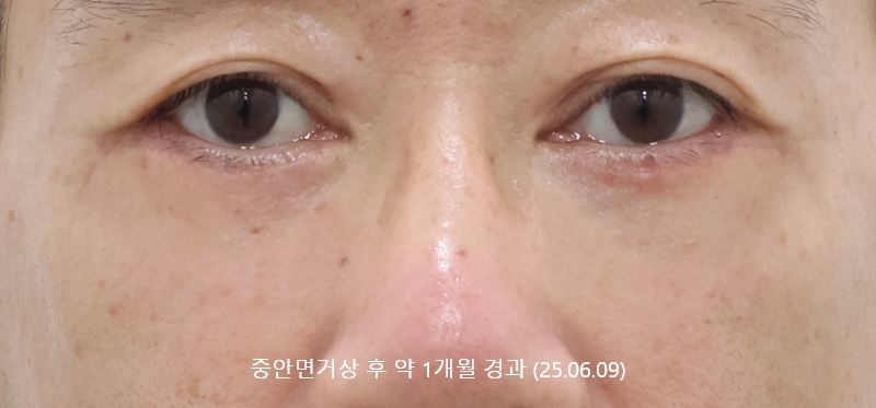 더올림성형외과 중안면거상 후사진 1개월경과