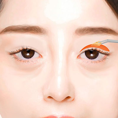 중년눈성형상안검수술방법2