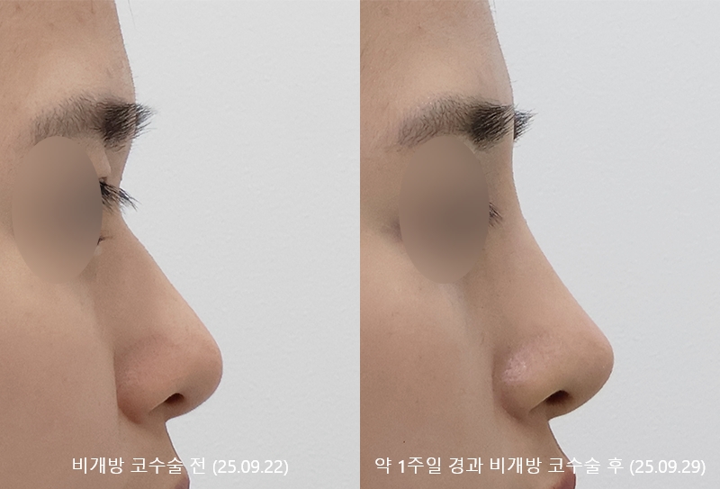 더올림성형외과 비개방코수술 1주일경과