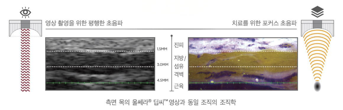 울쎄라의 콜라겐재생 최적온도