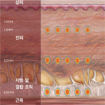 울쎄라 콜라겐생성 원리1