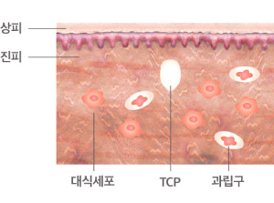 울쎄라 회복 과정1