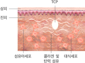 울쎄라 회복 과정2